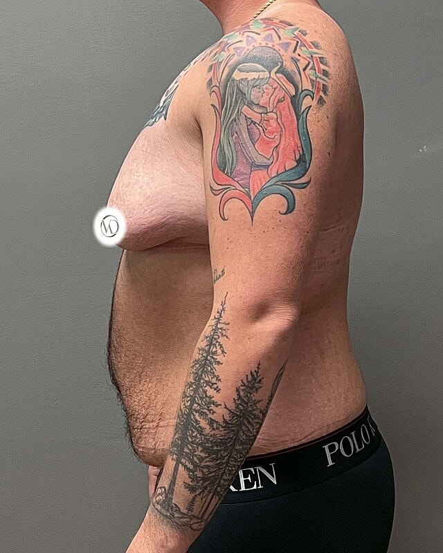 Tummy Tuck Before & After