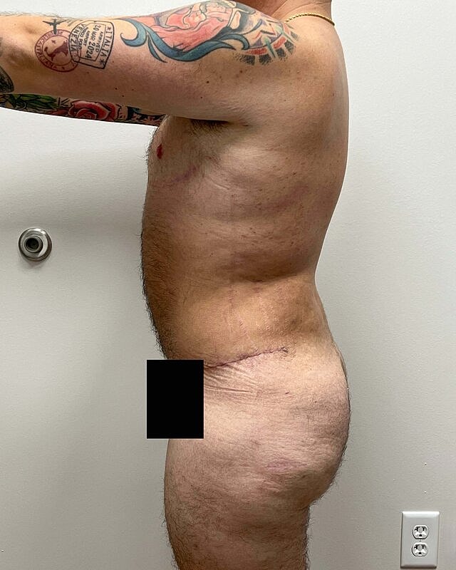 Tummy Tuck Before & After