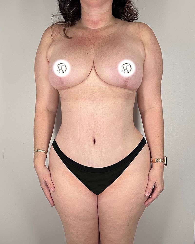 Tummy Tuck Before & After