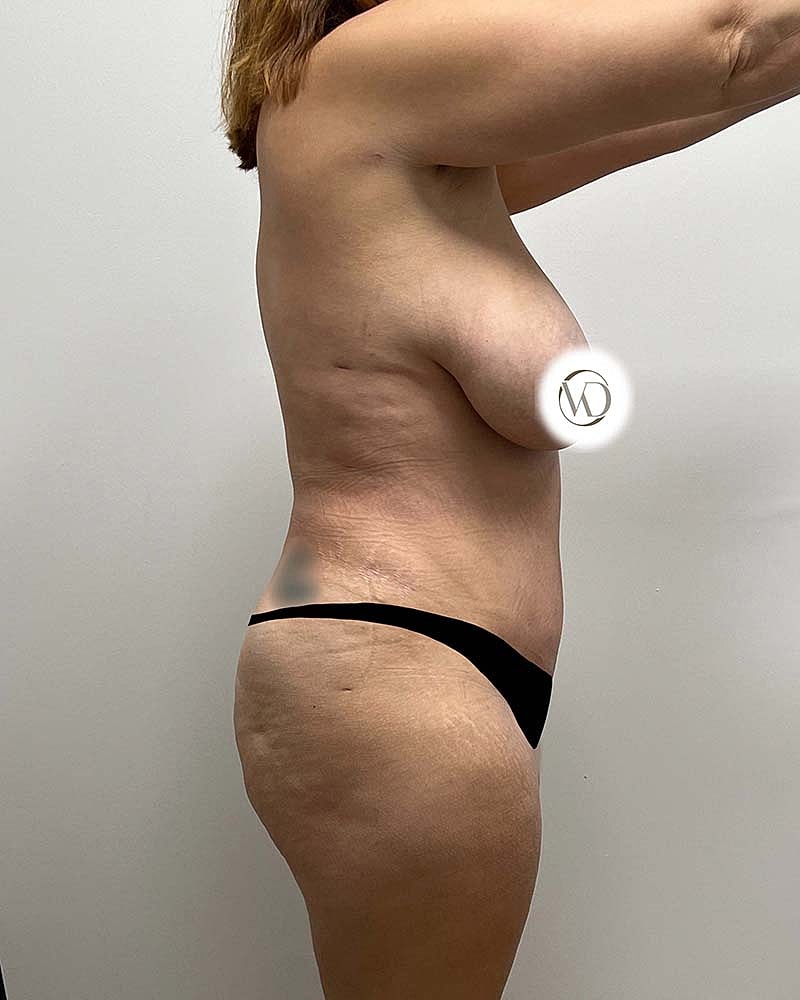 Tummy Tuck Before & After