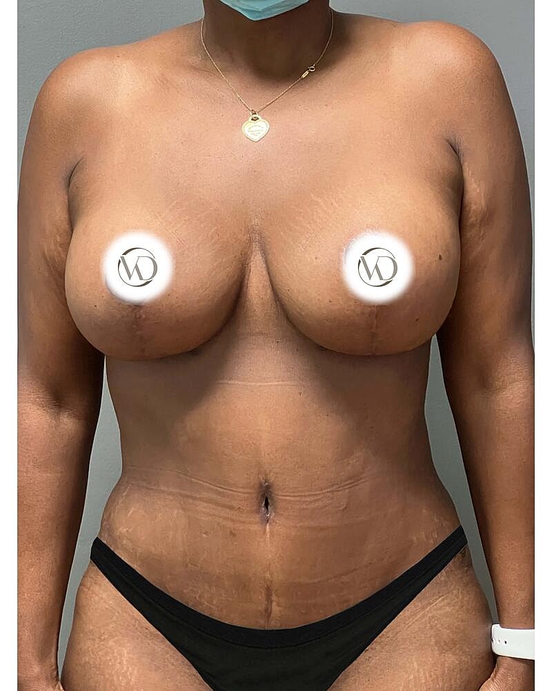 Tummy Tuck Before & After