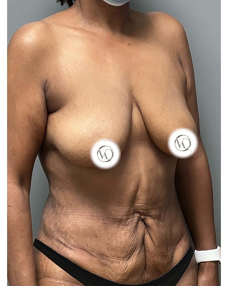 Tummy Tuck Before & After