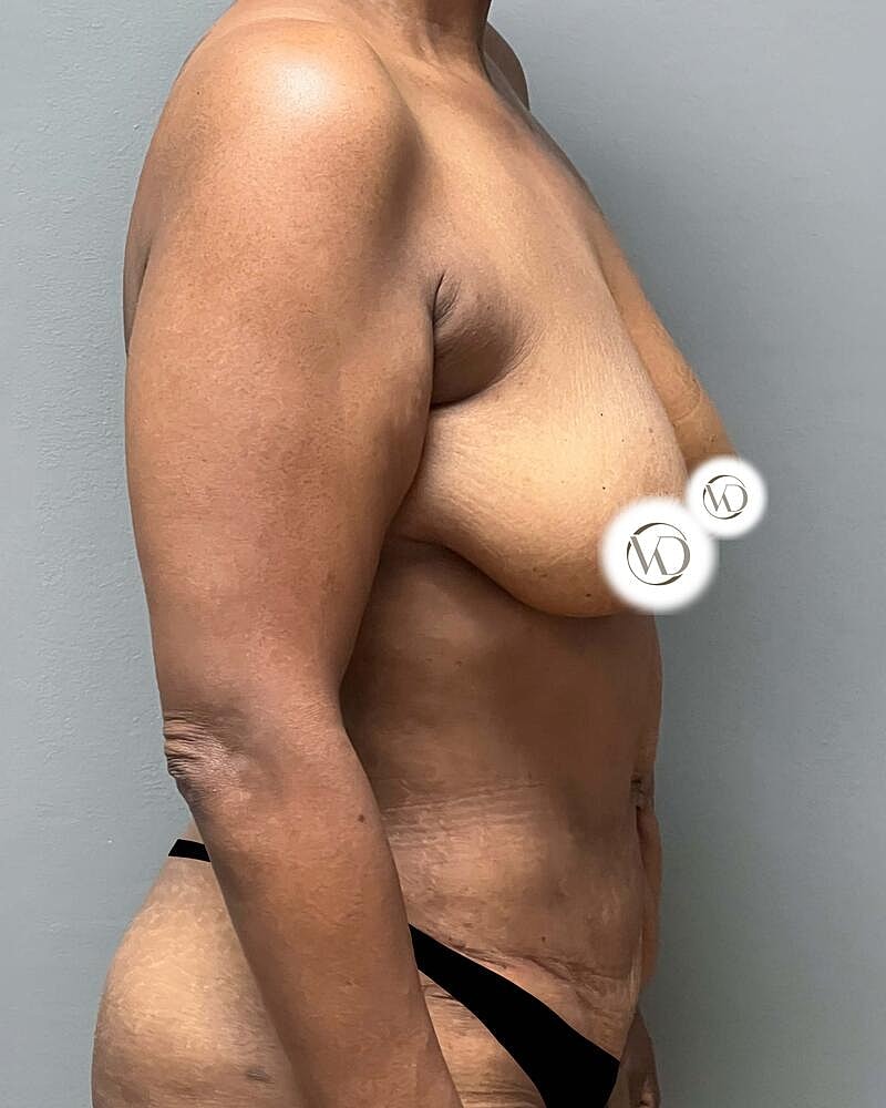 Tummy Tuck Before & After