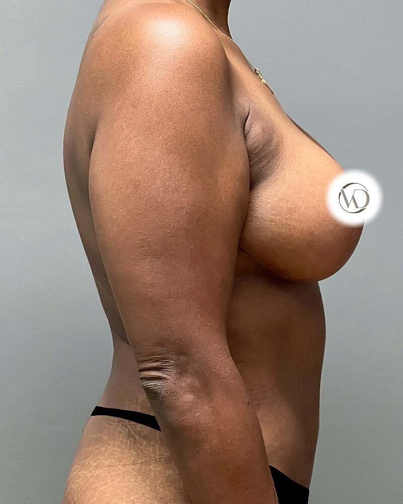 Tummy Tuck Before & After