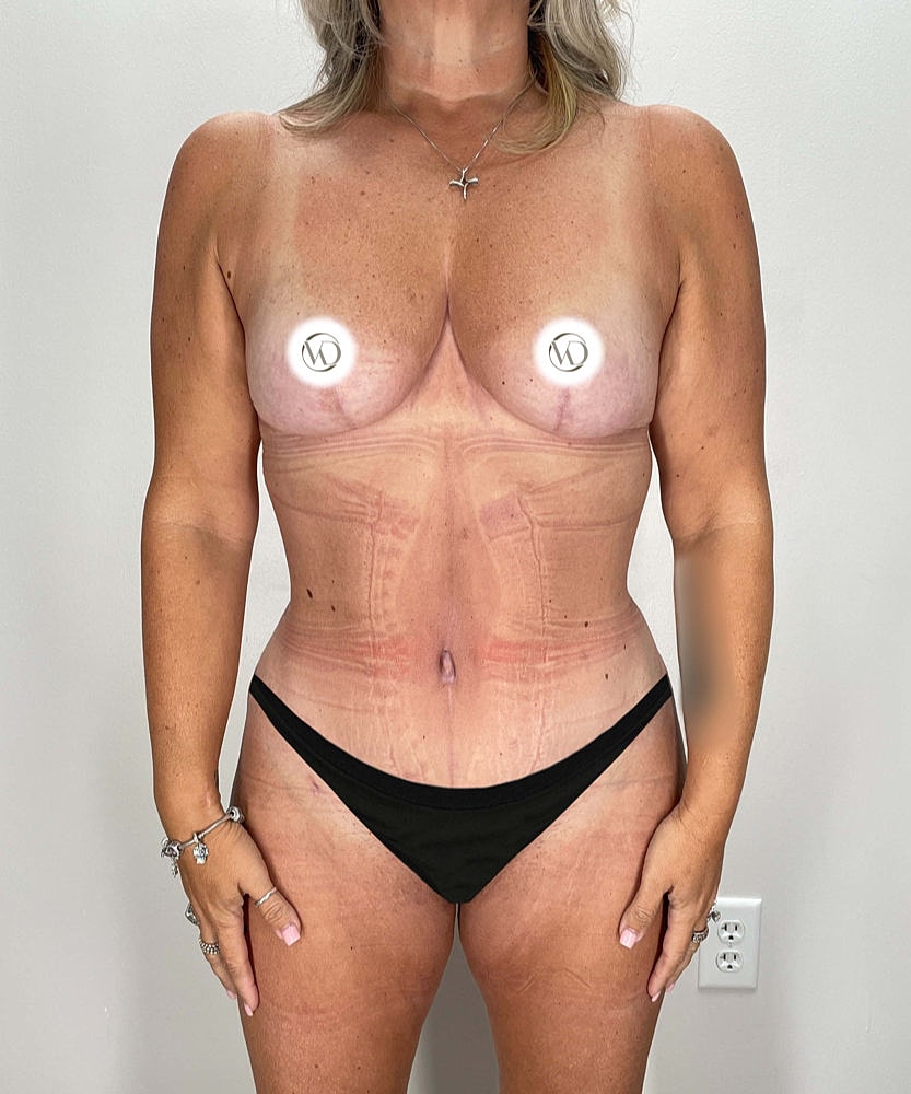 Tummy Tuck Before & After
