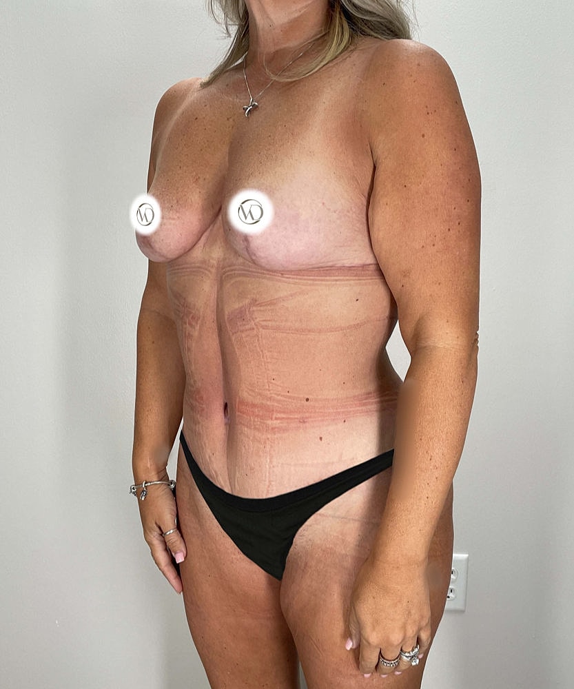 Tummy Tuck Before & After