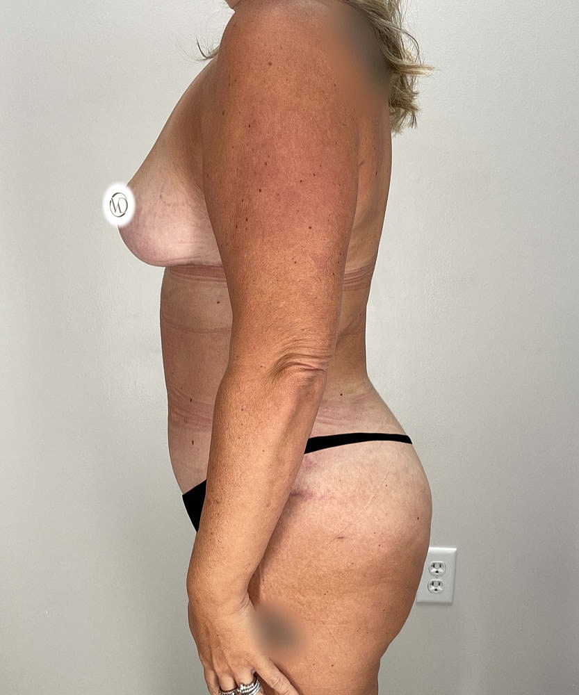 Tummy Tuck Before & After