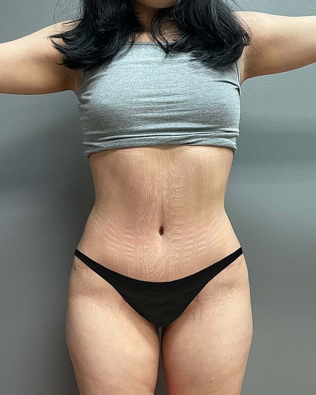 Tummy Tuck Before & After
