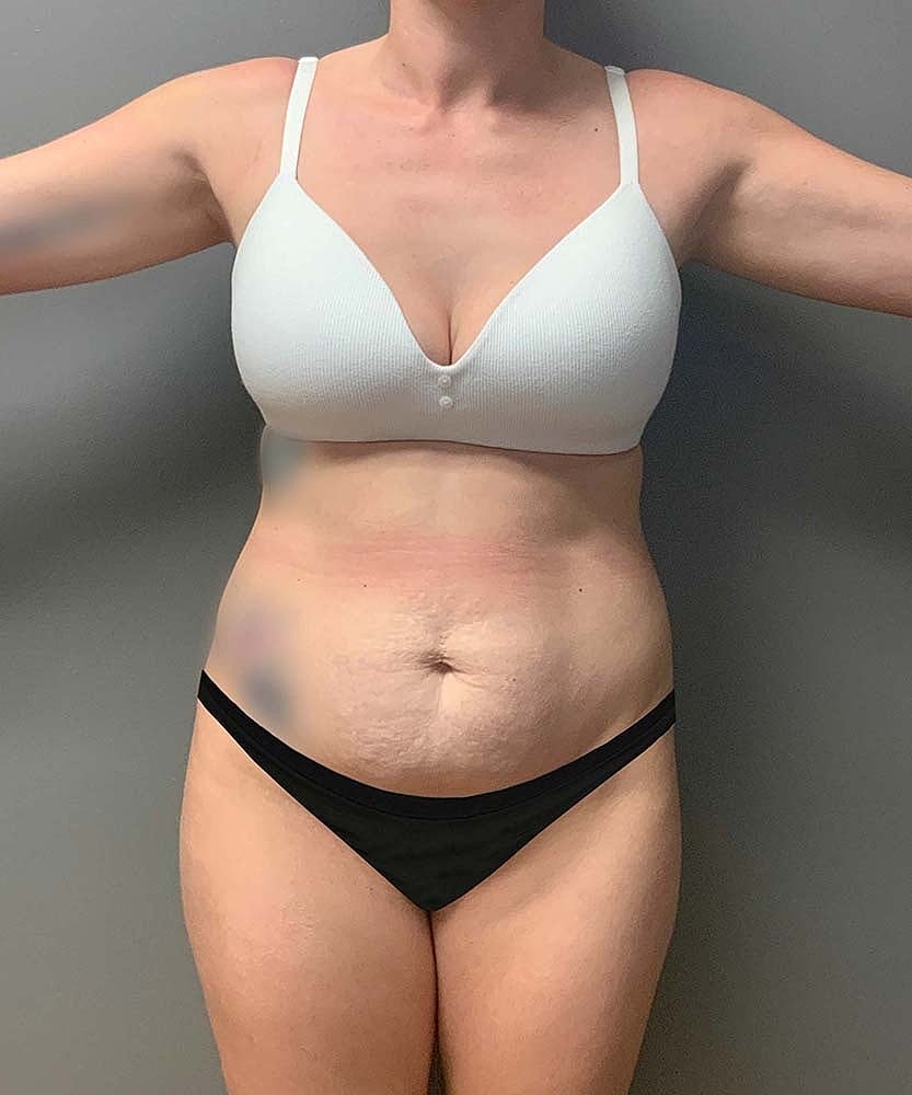 Tummy Tuck Before & After