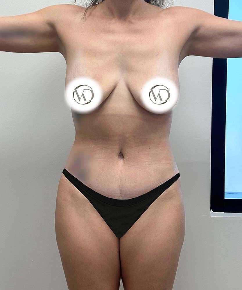 Tummy Tuck Before & After