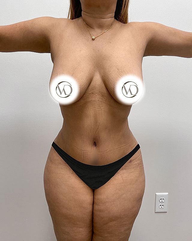 Tummy Tuck Before & After