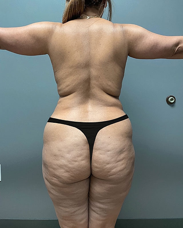 Tummy Tuck Before & After