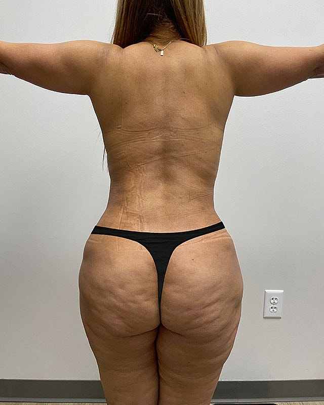 Tummy Tuck Before & After