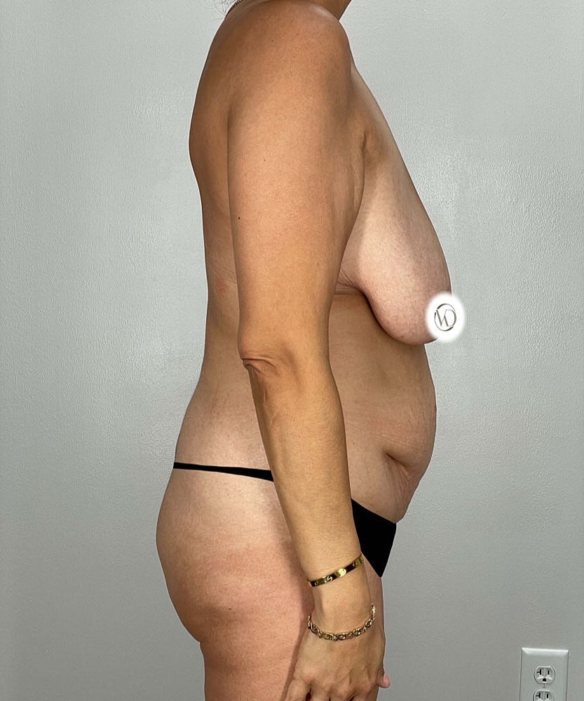 Tummy Tuck Before & After