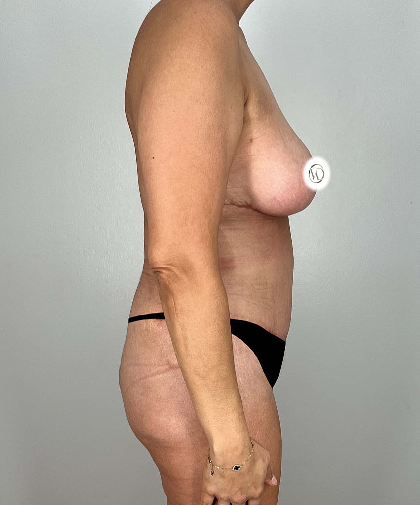 Tummy Tuck Before & After