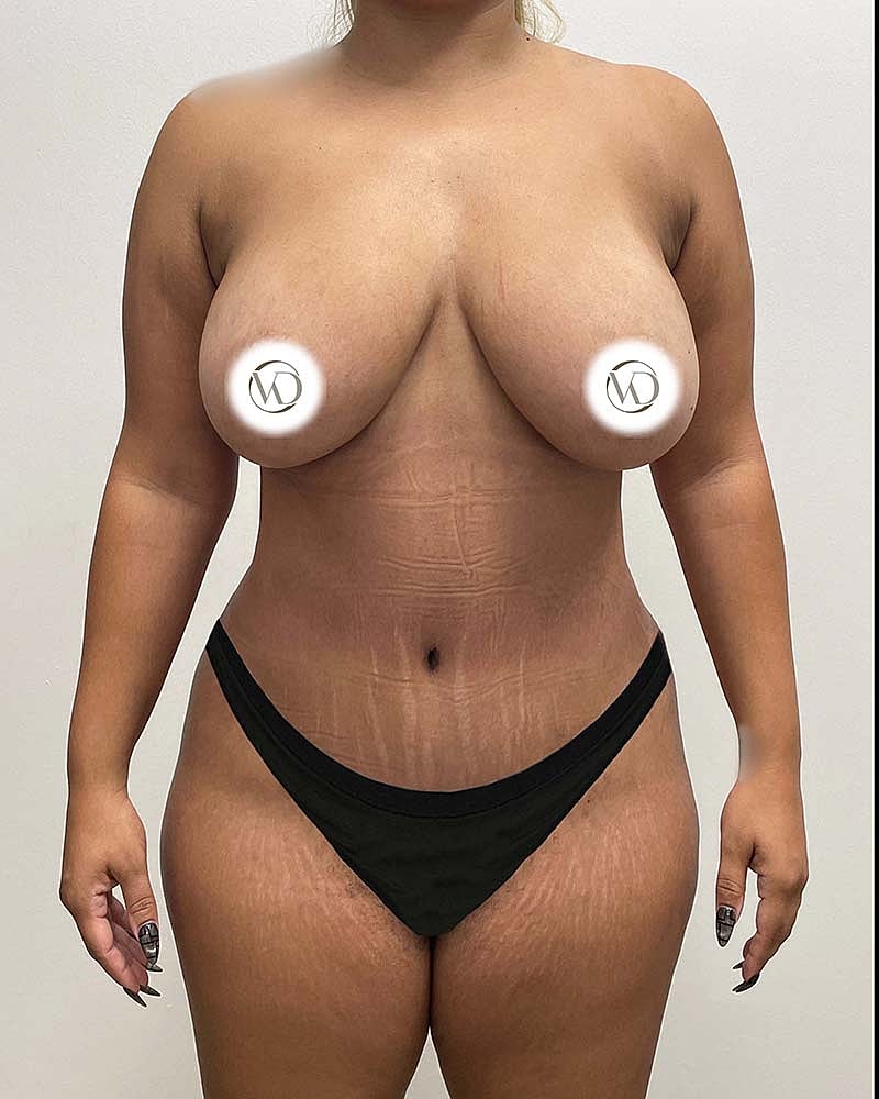 Tummy Tuck Before & After