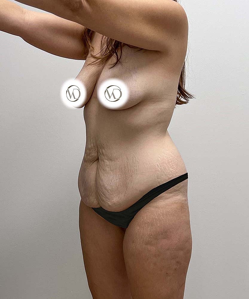 Tummy Tuck Before & After