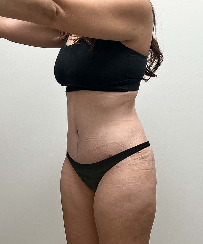 Tummy Tuck Before & After
