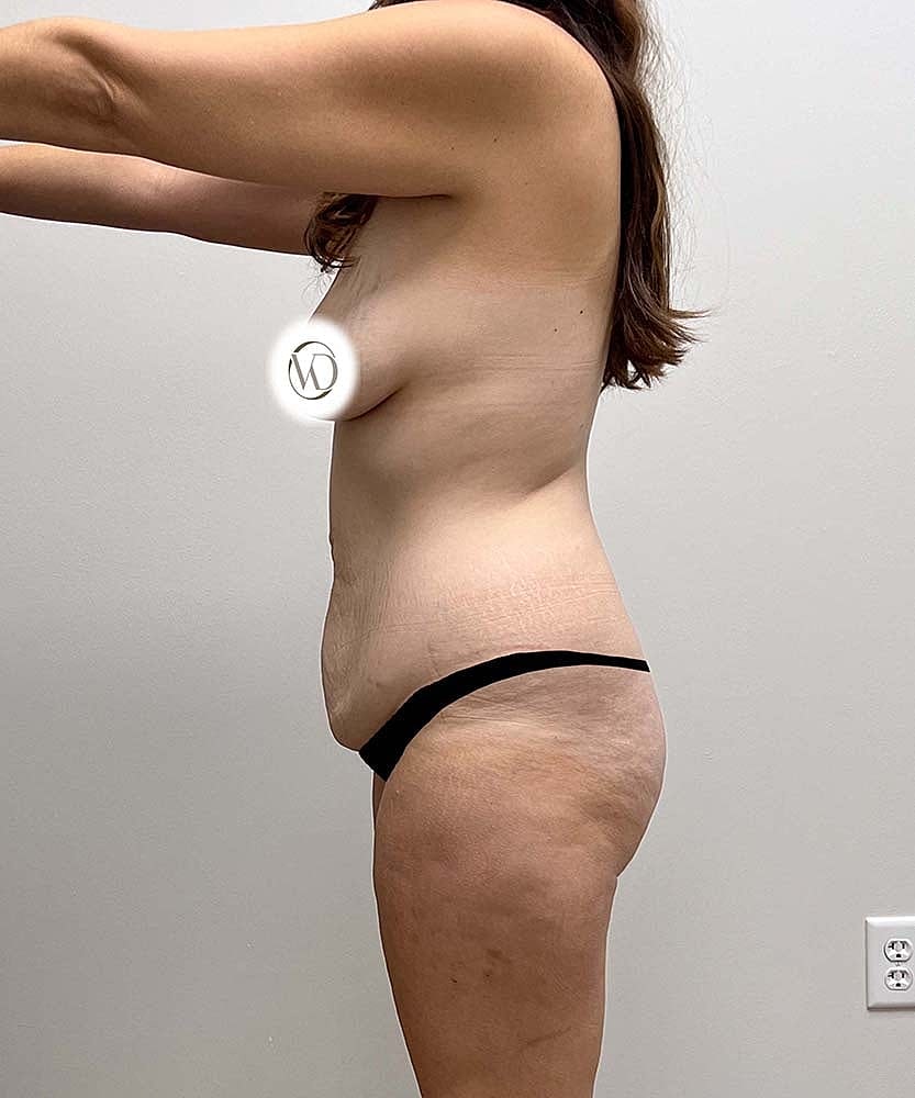 Tummy Tuck Before & After