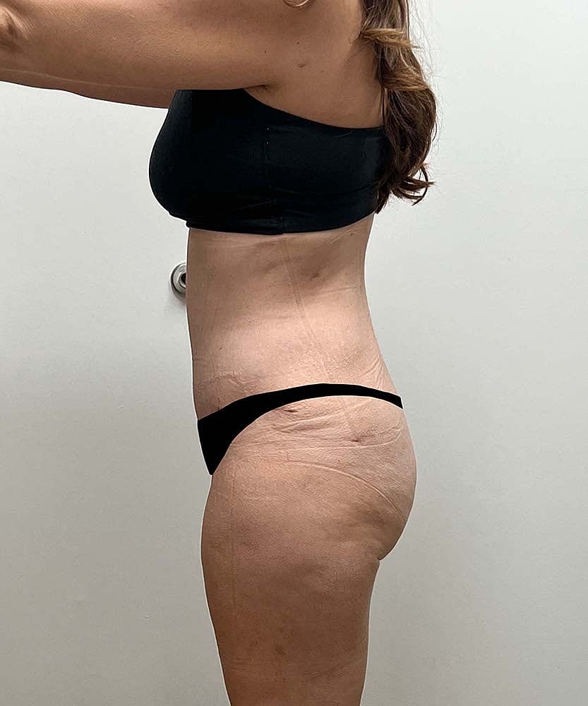 Tummy Tuck Before & After