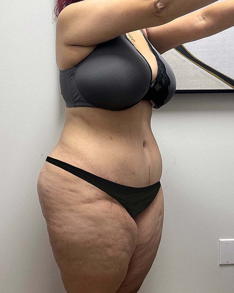 Tummy Tuck Before & After