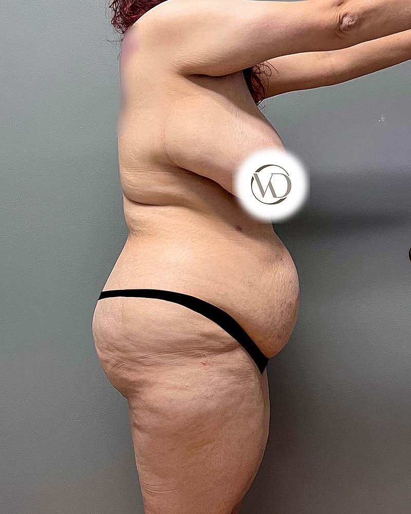 Tummy Tuck Before & After
