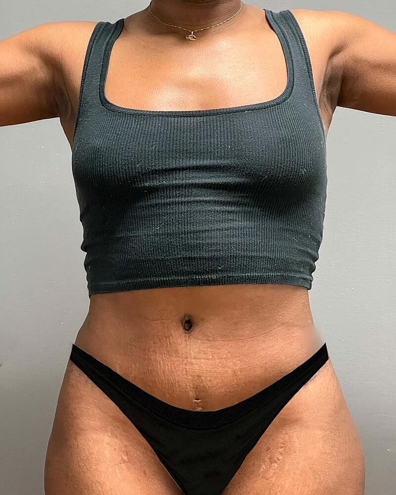 Tummy Tuck Before & After
