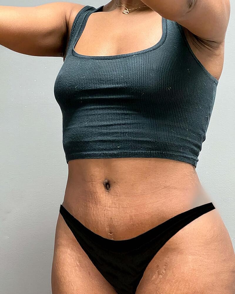 Tummy Tuck Before & After