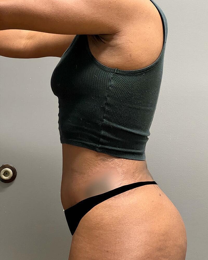 Tummy Tuck Before & After