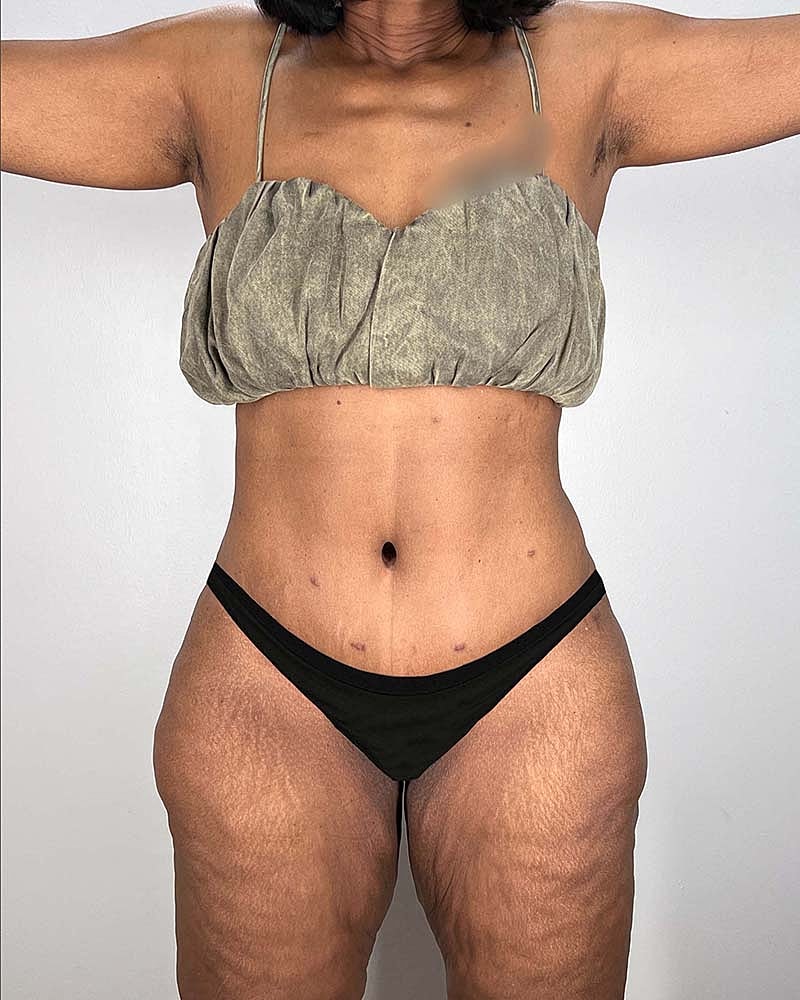 Tummy Tuck Before & After