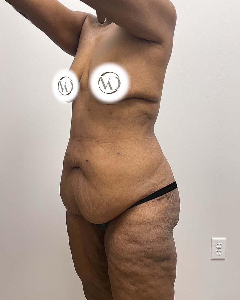 Tummy Tuck Before & After