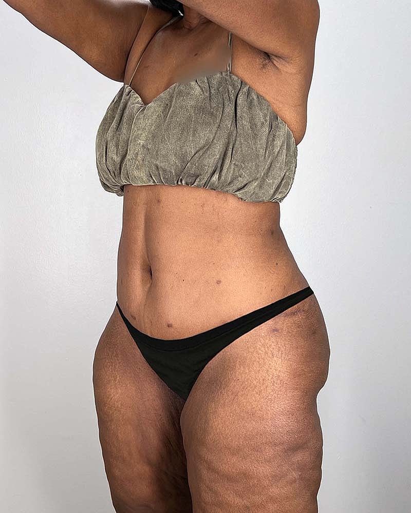 Tummy Tuck Before & After