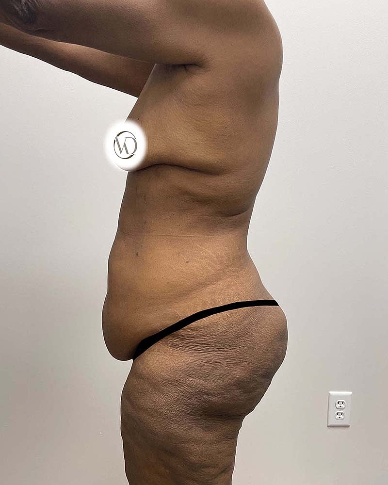 Tummy Tuck Before & After