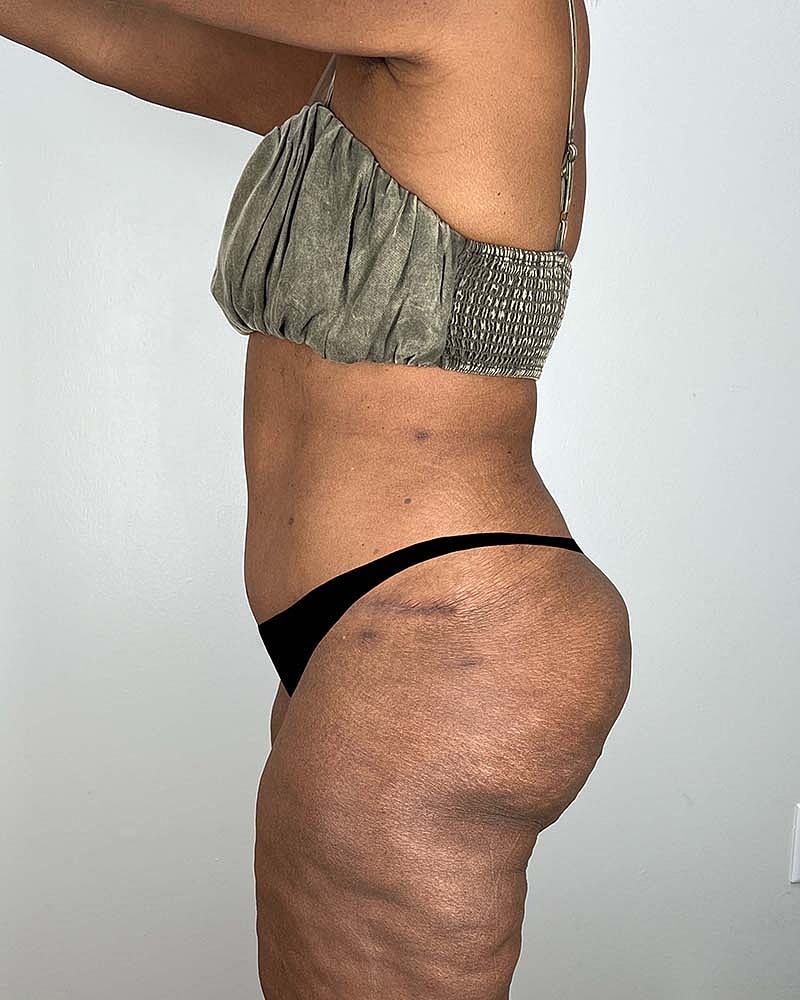 Tummy Tuck Before & After