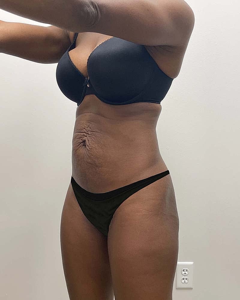 Tummy Tuck Before & After