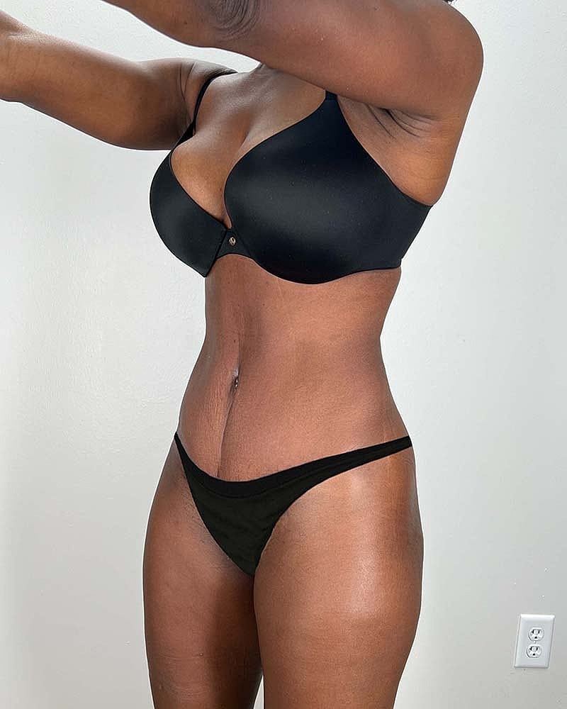 Tummy Tuck Before & After