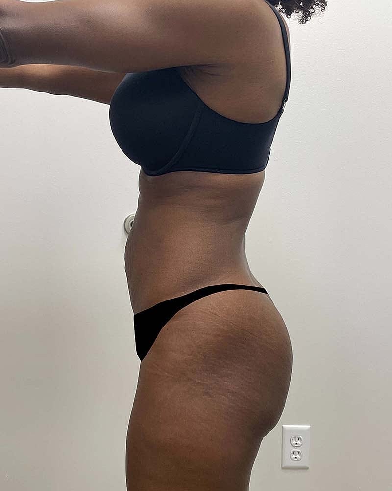 Tummy Tuck Before & After