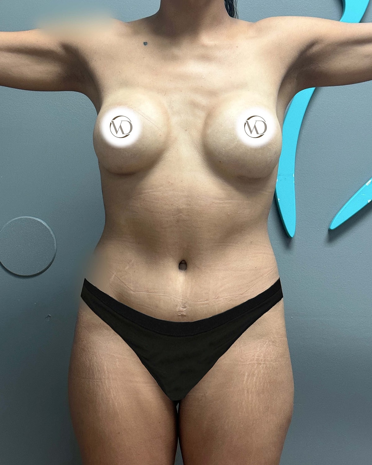 Tummy Tuck Before & After