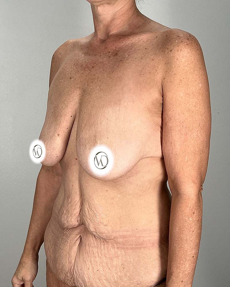 Tummy Tuck Before & After