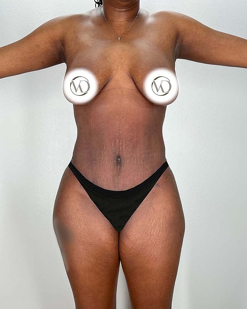 Tummy Tuck Before & After