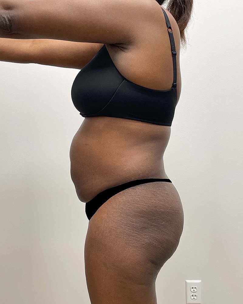 Tummy Tuck Before & After