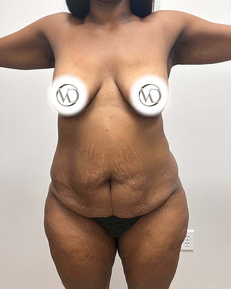 Tummy Tuck Before & After