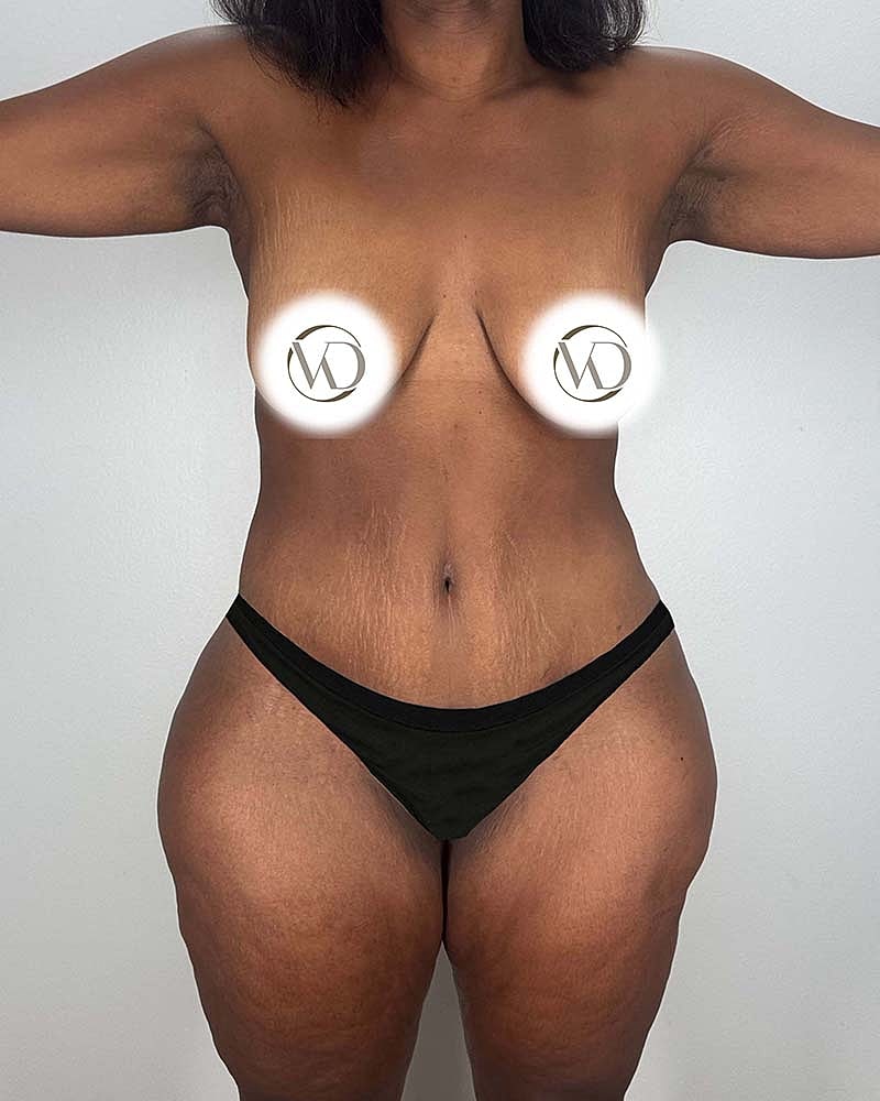 Tummy Tuck Before & After