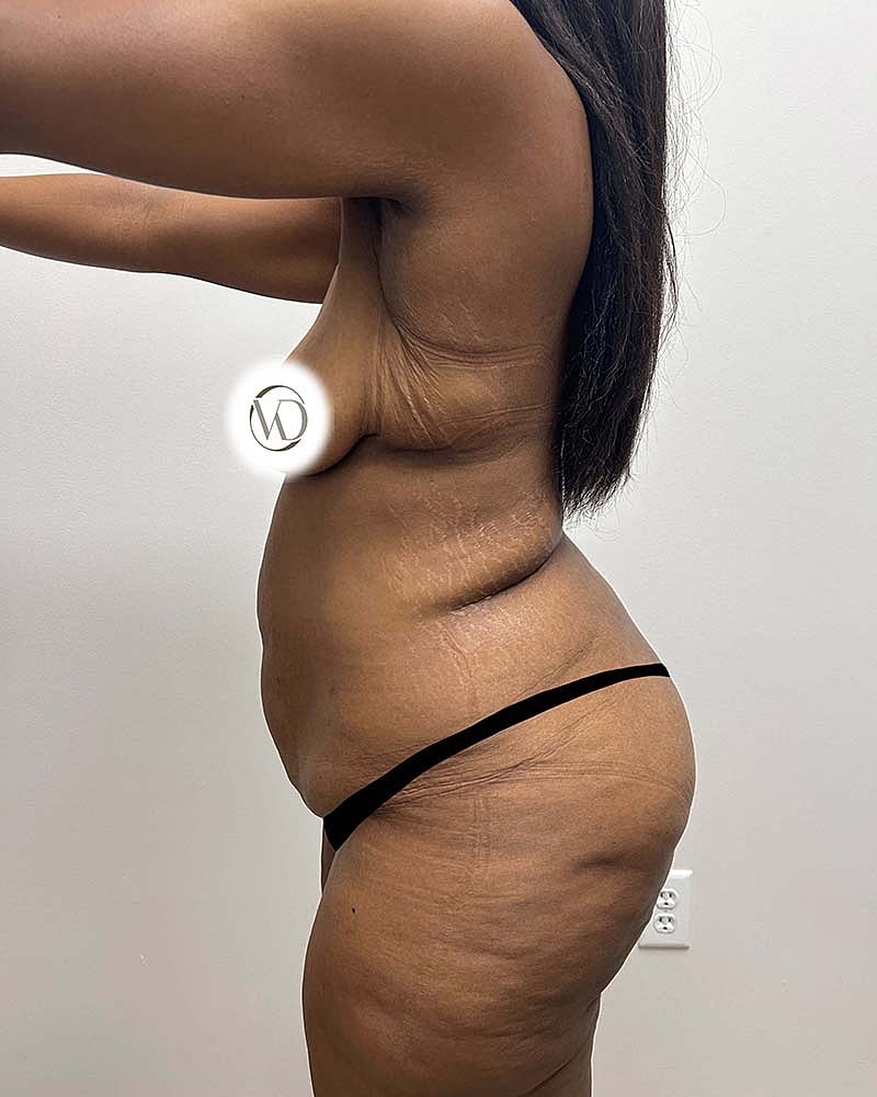 Tummy Tuck Before & After