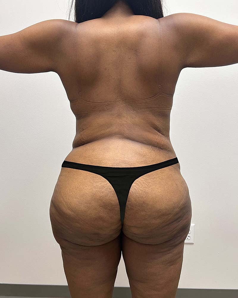 Tummy Tuck Before & After