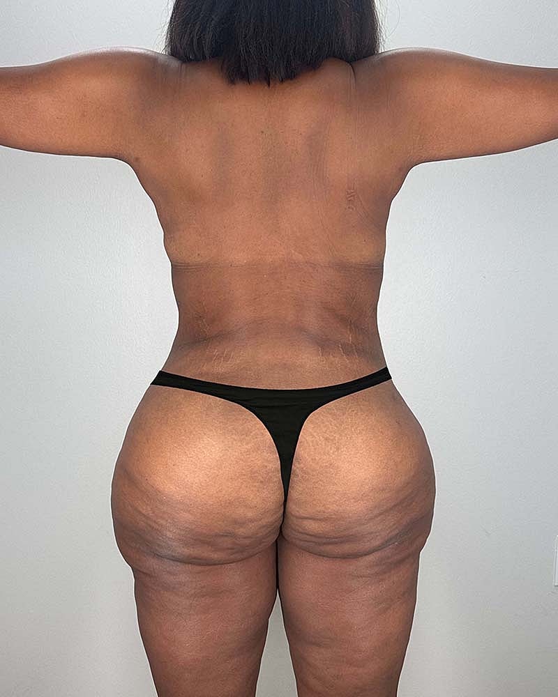 Tummy Tuck Before & After