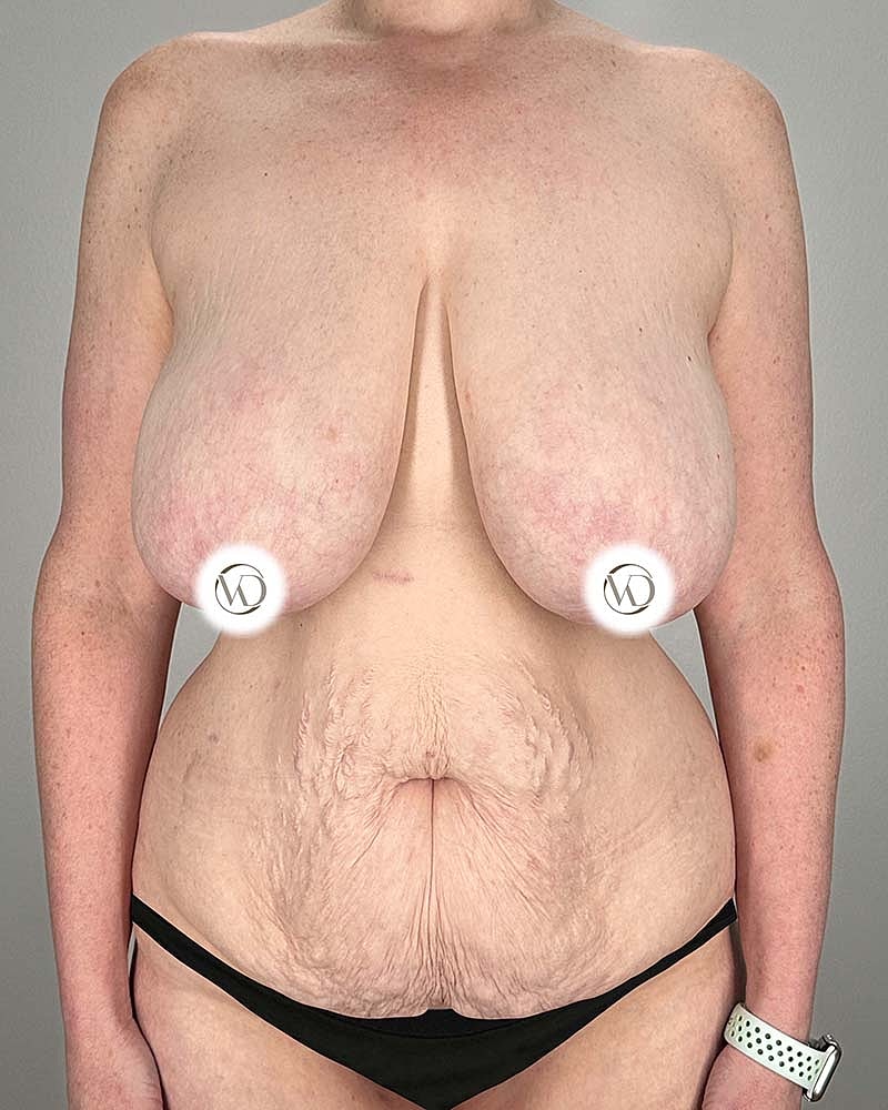 Tummy Tuck Before & After