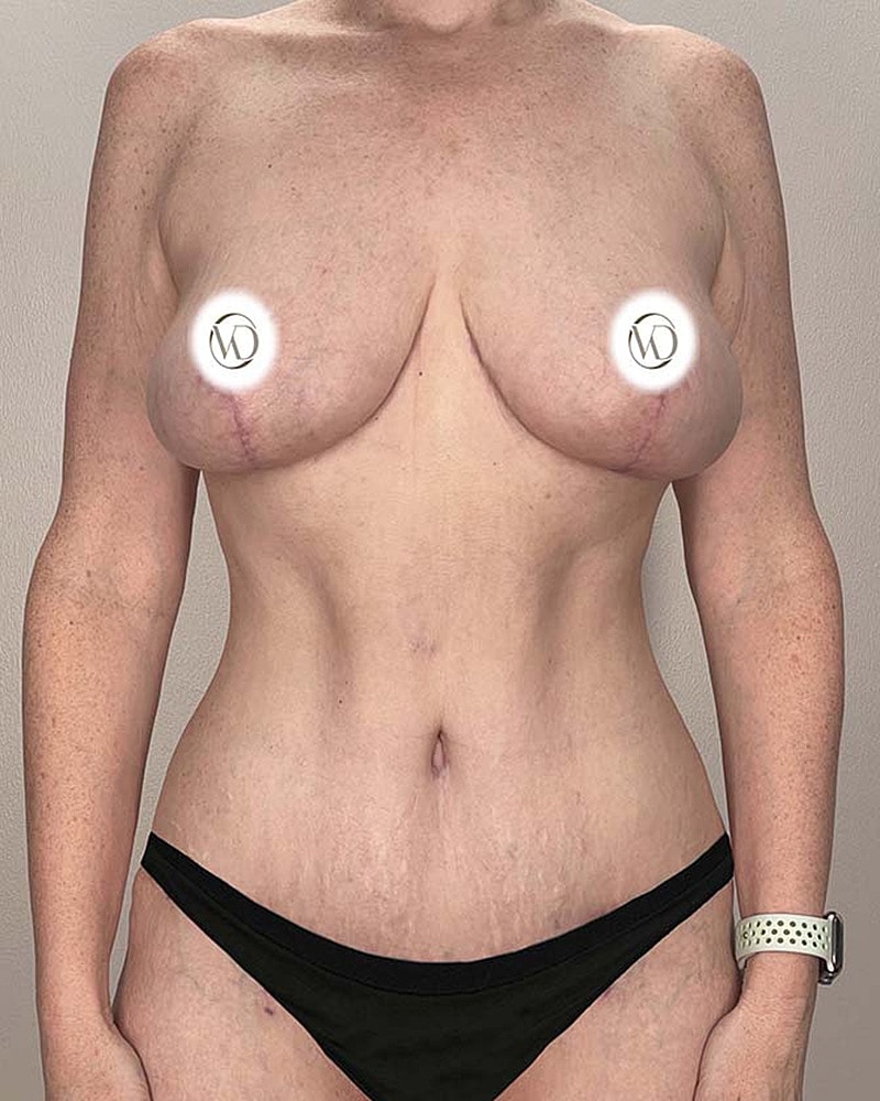 Tummy Tuck Before & After