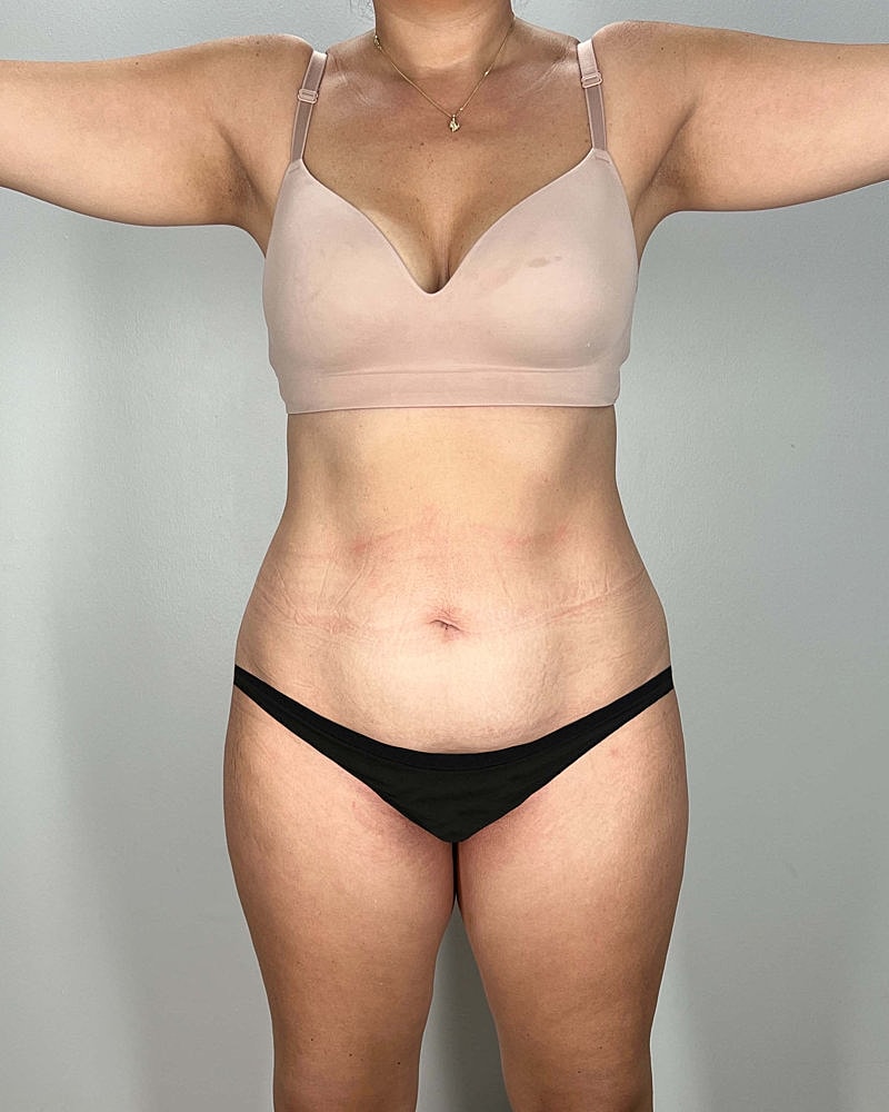 Tummy Tuck Before & After