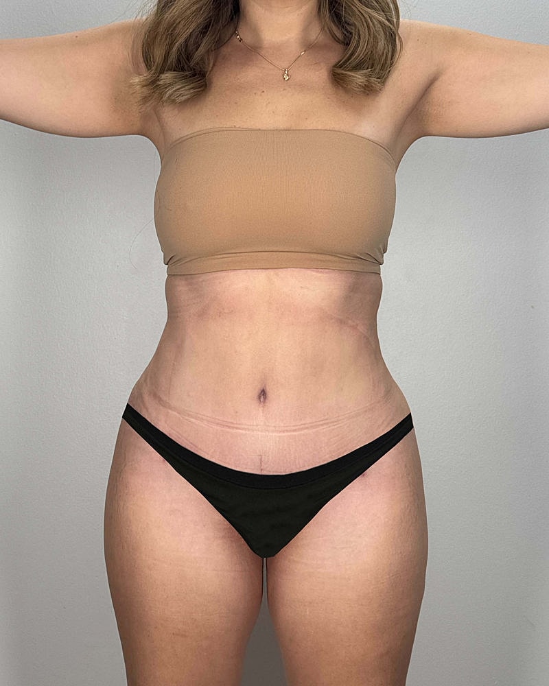 Tummy Tuck Before & After